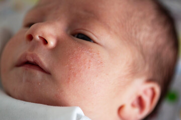 Pimples on the face of a newborn. Baby's adaptation to the environment, close-up