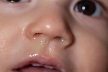 Yellow snot from a child s nose, close-up. Sinus infections, colds and virus. Chronic runny nose,...