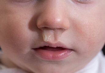 Close-up of a small child's face and nose with snot. The concept of colds, rhinitis and runny nose in children. - obrazy, fototapety, plakaty