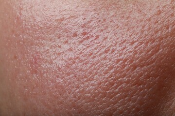 Closeup view of human oily skin as background - obrazy, fototapety, plakaty