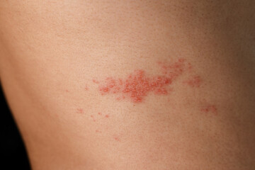 Man with shingles disease, skin infected with Herpes zoster, virus, Healthcare and medical. - obrazy, fototapety, plakaty
