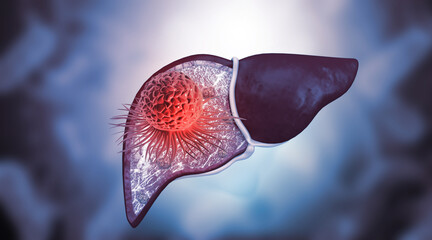 Human liver  anatomy with cancer cells. 3d illustration. - obrazy, fototapety, plakaty