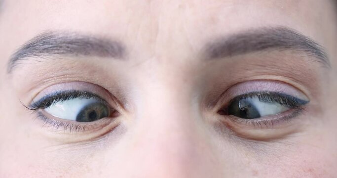 Adult woman eyes with squint. Vision restoration and strabismus treatment concept