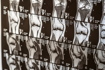 Knee joint x-ray or MRI. Doctor pointed on area of knee joint, where pathology or problem is...