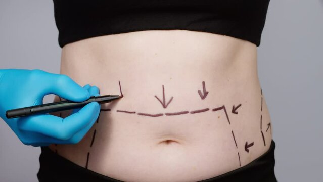 Liposuction concept. Plastic surgery to remove fat deposits on the abdomen. The doctor's hand draws a dotted line. Cellulite on the stomach.