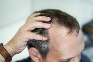 Baldness on the head of a middle-aged man. Hair loss.