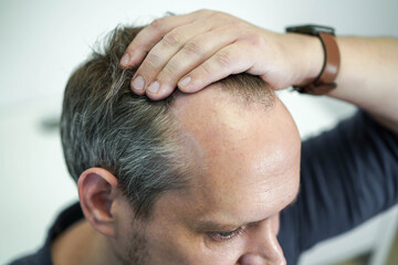 Obraz na płótnie Canvas Baldness on the head of a middle-aged man. Hair loss.