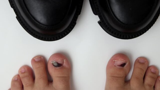 hematoma wound on runner's toe nail. consequences of wearing uncomfortable shoes or hit.feet on white or carpet,blue medicinal sheet,pills blisters,syringe.doctor hand in glove holding finger.