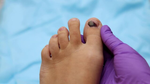 hematoma wound on runner's toe nail. consequences of wearing uncomfortable shoes or hit.feet on white or carpet,blue medicinal sheet,pills blisters,syringe.doctor hand in glove holding finger.