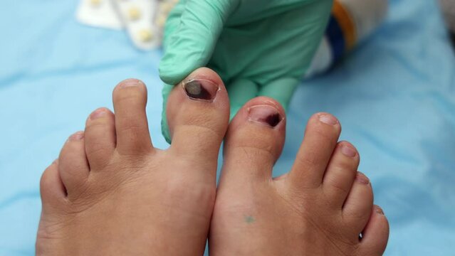 hematoma wound on runner's toe nail. consequences of wearing uncomfortable shoes or hit.feet on white or carpet,blue medicinal sheet,pills blisters,syringe.doctor hand in glove holding finger.