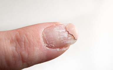 Close up view of layers peeling off damaged finger nail after UV nail polish usage. Home indoors.