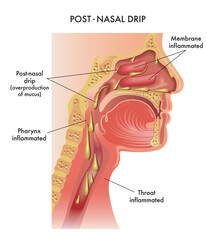 Medical illustration of symptoms of Post-Nasal Drip, with annotations. - obrazy, fototapety, plakaty