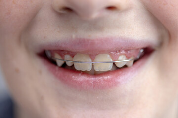 Obraz premium Wide smile of teenage boy, teeth with braces close-up. Young student smiling mouth portrait showing teeth with braces closeup. The concept of dentistry and orthodontics.