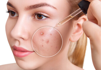 Zoom circle shows acne skin before and after applying cosmetics remedy.
