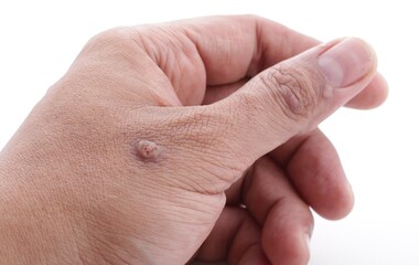 Warts in medical terms are called Papillomas. Papilloma is actually a type of benign tumor on the skin, originating from excessive thickening of the outer layer of the skin. 