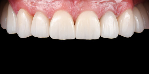 Emax crowns and veneers 