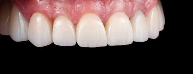 Emax crowns and veneers 