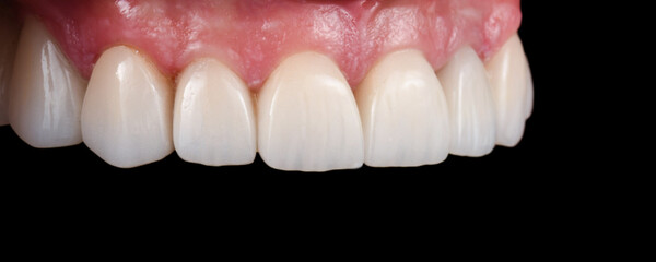 Emax crowns and veneers 