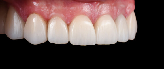 Obraz premium Emax crowns and veneers 