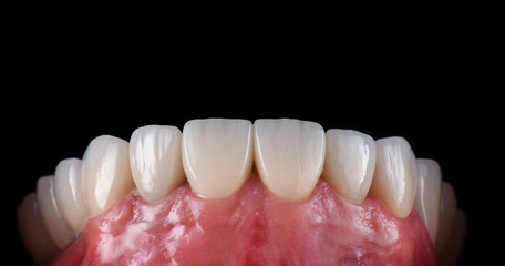 Emax crowns and veneers 