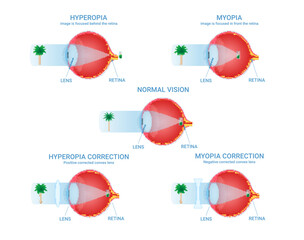 Vision defects visual impairment normal myopia hyperopia correction infographic scheme vector flat - obrazy, fototapety, plakaty