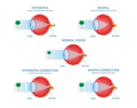 Vision defects visual impairment normal myopia hyperopia correction infographic scheme vector flat