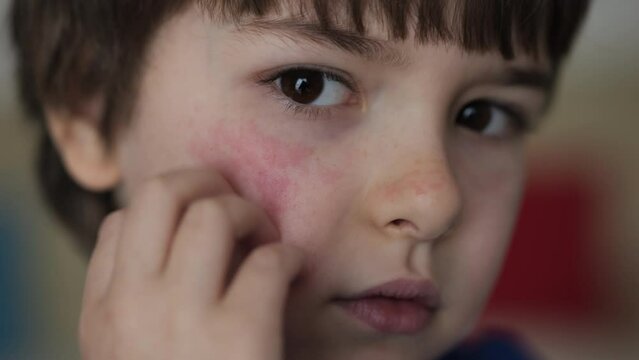 Boy Has Dry Red Skin and Scratching Her Face. Child Scratches Atopic Skin. Dermatitis, Diathesis, Allergy on Child Body and Face. Irritation and Pruritus. Boy Having Allergic Reaction on Skin to Food.