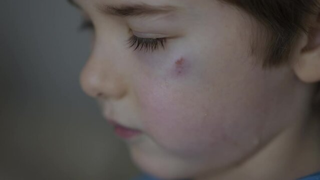 Portrait of Face of Unhappy Boy With Blue And Red Bruise Near Eye. Sad Little Child After Fight Looks at Camera Sadly. Child Has Painful Wound and Bruise Near Her Eye. Domestic Violence Child Abuse.