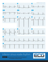 Male, 29 years old, clinically diagnosed with nasal septal malformation. Preoperative ECG is normal, note the J waves in the inferior leads.They are physiological J waves.