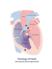 Four anatomical malformations of tetralogy of Fallot: 1 aortic straddling; 2 ventricular septal defect; 3 right ventricular hypertrophy and 4 pulmonary artery stenosis.