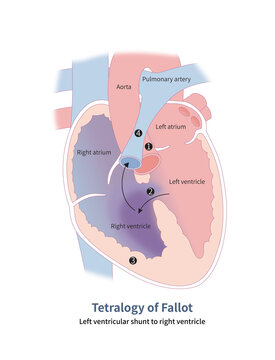 Four anatomical malformations of tetralogy of Fallot: 1 aortic straddling; 2 ventricular septal defect; 3 right ventricular hypertrophy and 4 pulmonary artery stenosis.