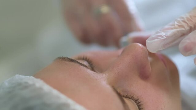 Nasolabial fold correction in progress, with clinical accuracy. Speaks to the personal investment in cosmetic self-improvement.