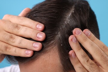 Naklejka premium Man with dandruff in his dark hair on light blue background, closeup