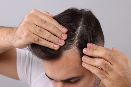 Man with dandruff in his dark hair on light grey background, closeup