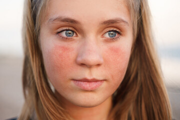 Naklejka premium Portrait of a girl with a burnt face, sunburn. Beauty care from skin problem treatment