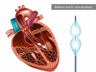 Balloon aortic valvuloplasty or BAV. The balloon catheter is advanced. Aortic stenosis, or narrowing of the aortic valve. - obrazy, fototapety, plakaty