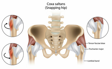 Coxa Saltans or Snapping Hip Snapping Hip Syndrome also referred to as dancer hip. - obrazy, fototapety, plakaty