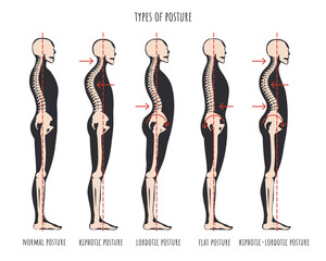 Type of posture, postural syndromes infographic. Skeletal samples of back problem kyphosis, lordosis and flat back. Normal posture medical educational poster. Vector illustration.