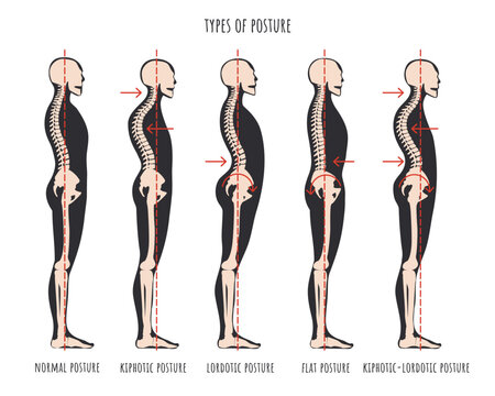 Type of posture, postural syndromes infographic. Skeletal samples of back problem kyphosis, lordosis and flat back. Normal posture medical educational poster. Vector illustration.
