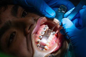 Teenage at the dental clinic putting bracket to correct teeth