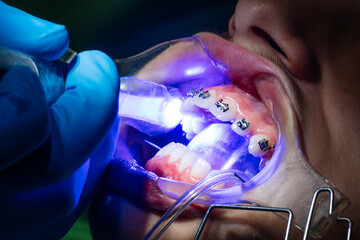 Teenage at the dental clinic putting bracket to correct teeth