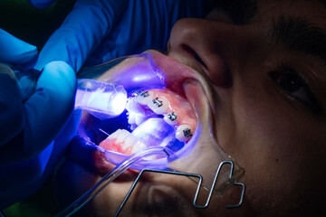 Teenage at the dental clinic putting bracket to correct teeth