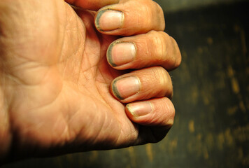 dirt under nails close-up. Dirt under the nails is a source of infection. lack of personal hygiene. 