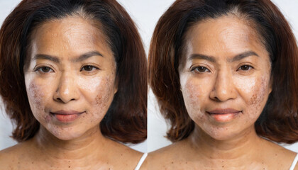cropped image before and after spot melasma pigmentation facial treatment on middle age asian woman face skincare and health problem concept - Powered by Adobe