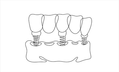 5 teeth. Dental bridge. One line © Anna
