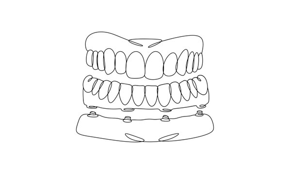 black line art teeth dental implants clip art preview