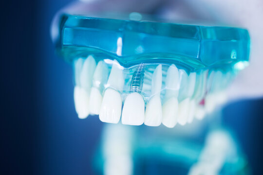 Dental tooth implant model