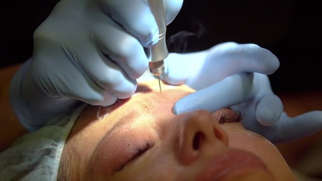 Skin treatment to improve facial wrinkles