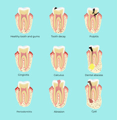 Dental diseases teeth caries pulpitis cyst gingivitis periodontitis. Medical illustration. Stomatology - obrazy, fototapety, plakaty