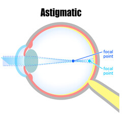 近視正乱視の眼球のイラスト